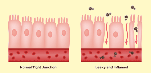 leaky gut